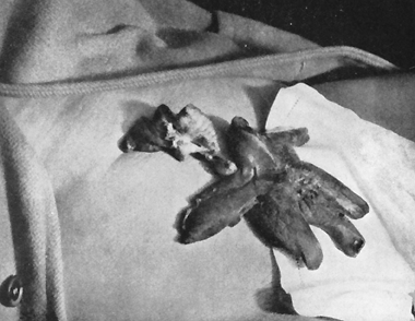 Ectoplasmic hand exuding from Margery's navel.